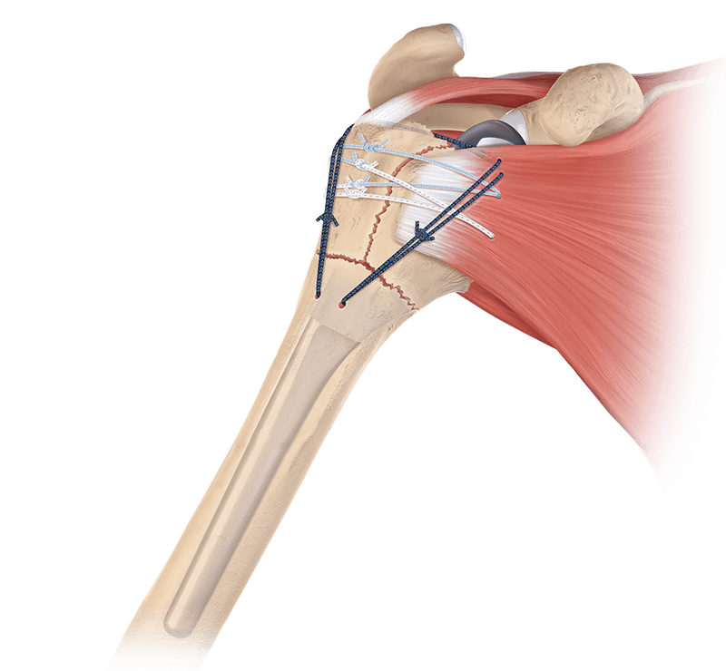 FxBridge™-Tuberositas-Rekonstruktionssystem