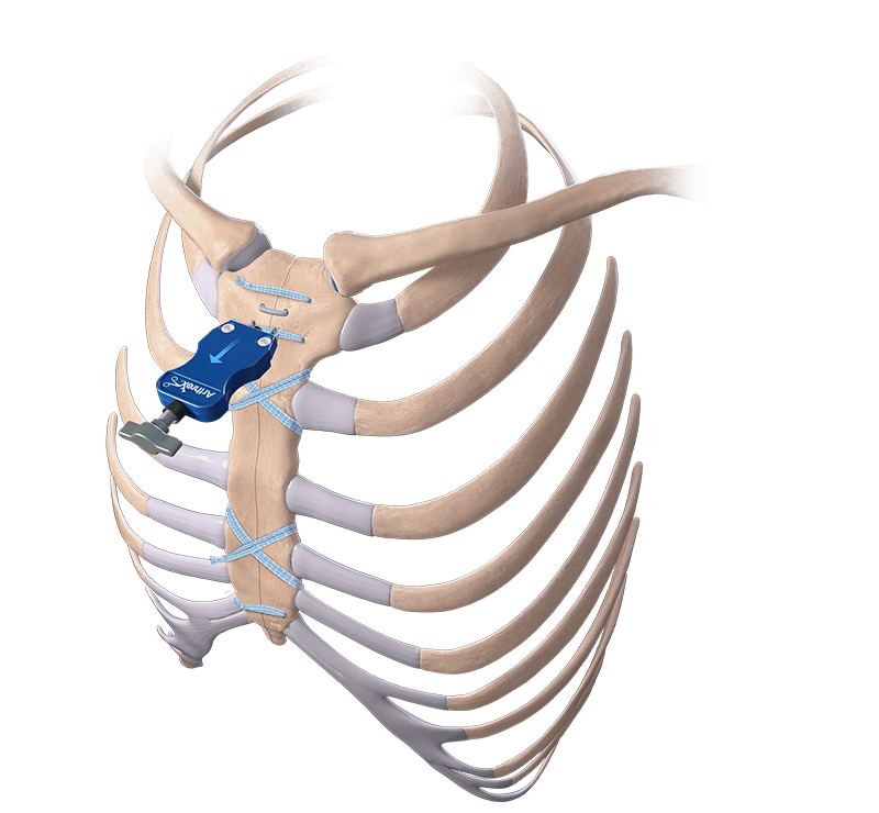 DynaNite® CT Nitinol Staples for Sternal Closure