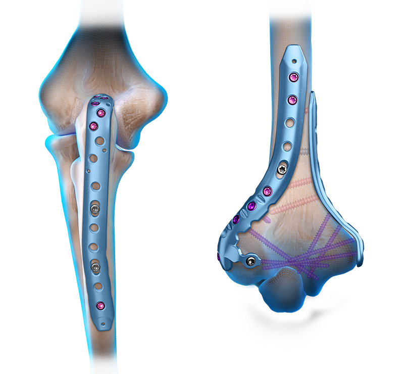 Elbow Fracture Plating System