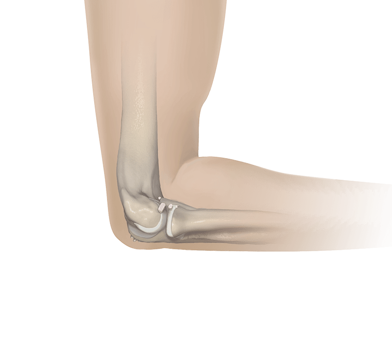 Posterior Medial Elbow Impingement