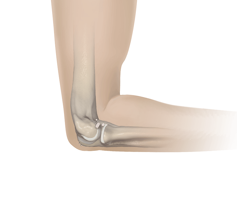 Pinzamiento posterior medial del codo