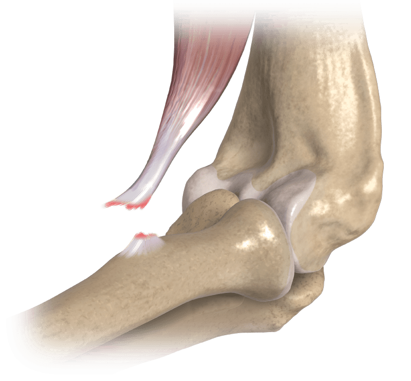 Distal Biceps Rupture