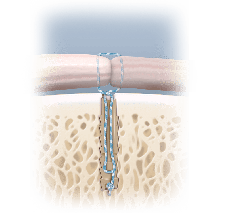 Lateral Epicondylitis