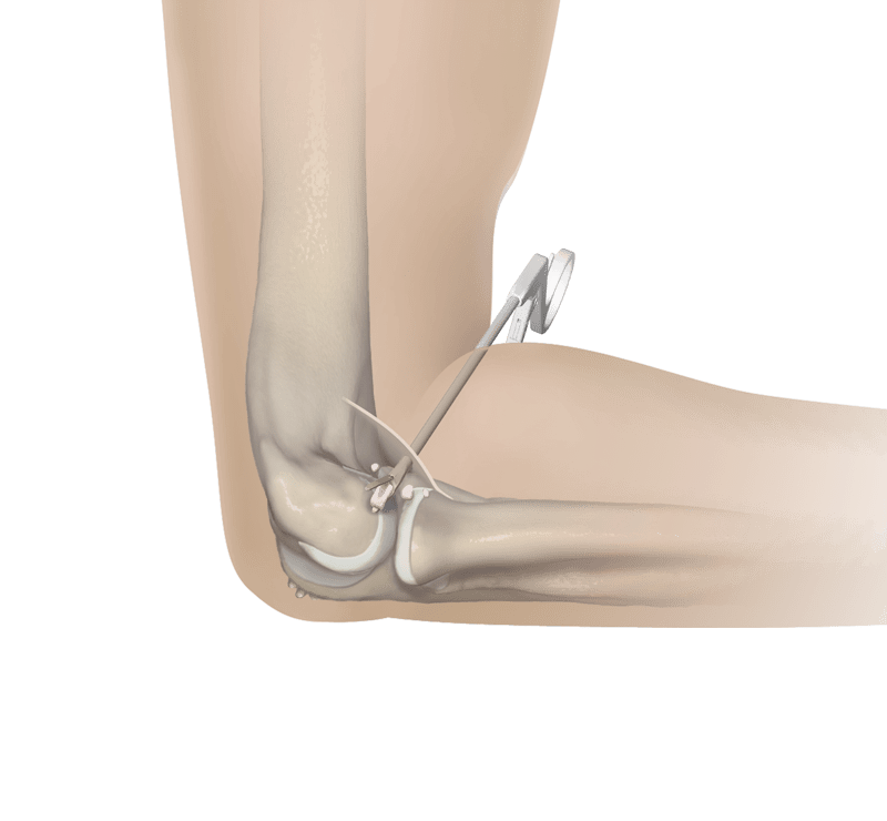 Removal of Osteophytes and Loose Bodies