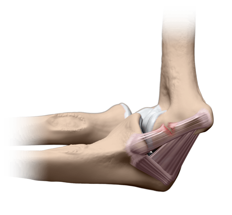Ulnar Collateral Ligament Tear