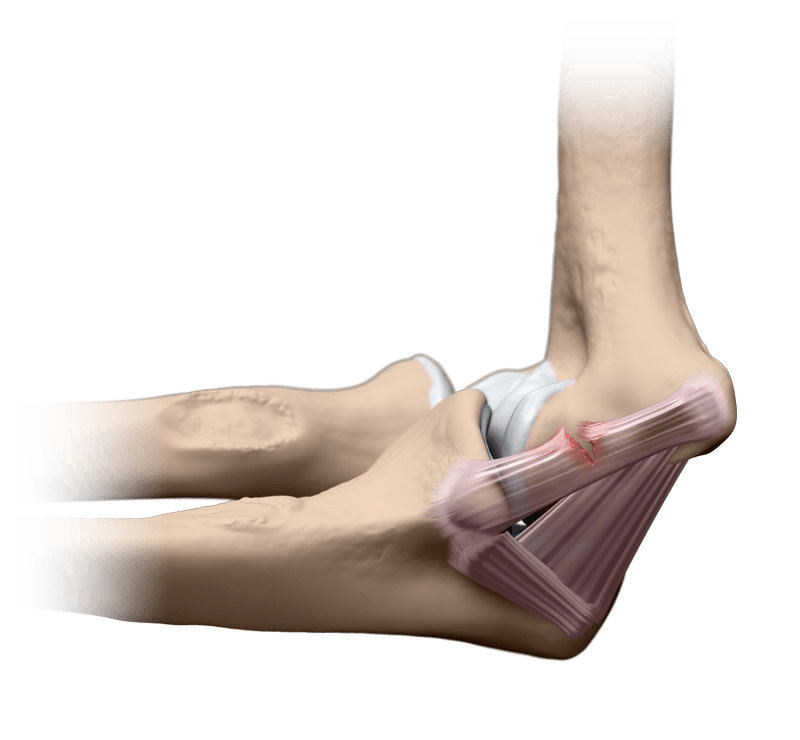 Ruptura del ligamento colateral cubital