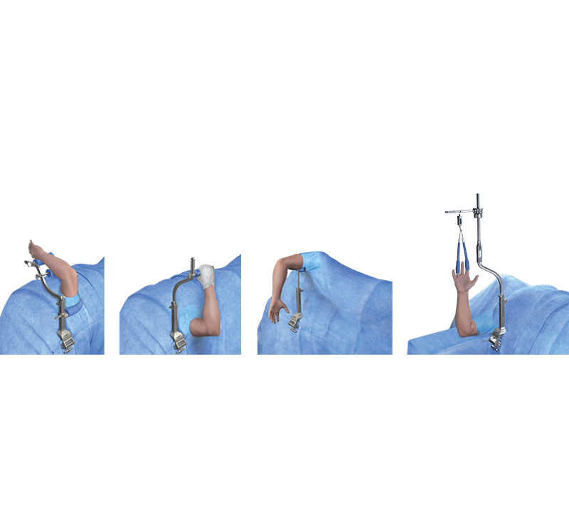 ElbowLOC® Arm Positioning System