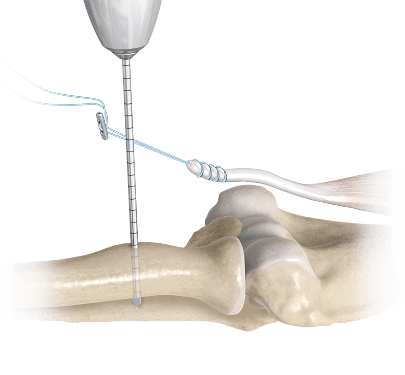 Cortical Button Fixation