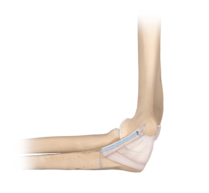 Sistema <em>Internal</em>Brace™ para LCC