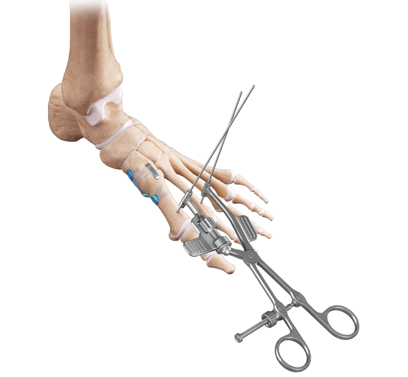 Lapidus Hallux Valgus Correction