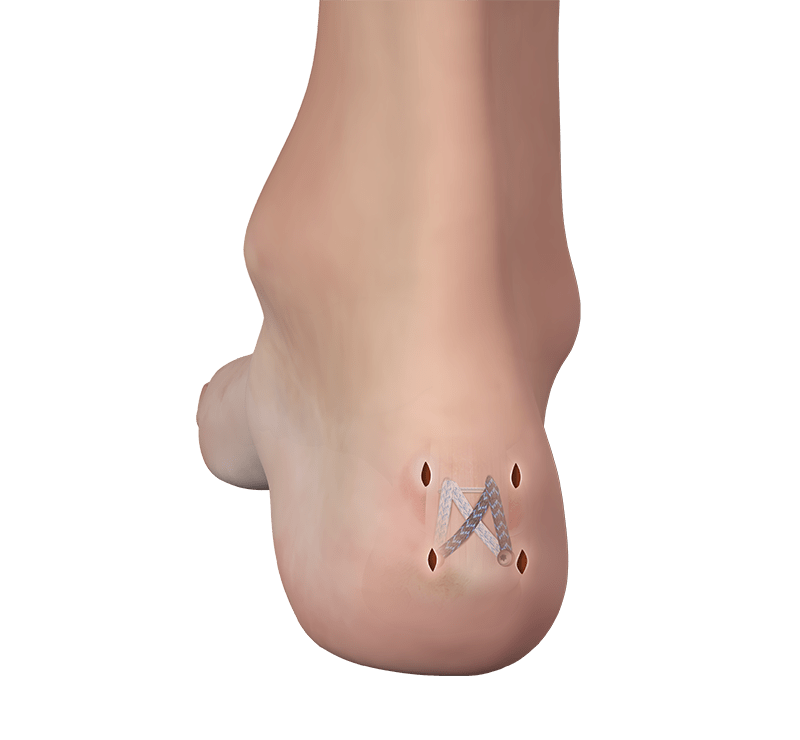 Minimally Invasive FiberTak® Achilles SpeedBridge™ Repair Implant System