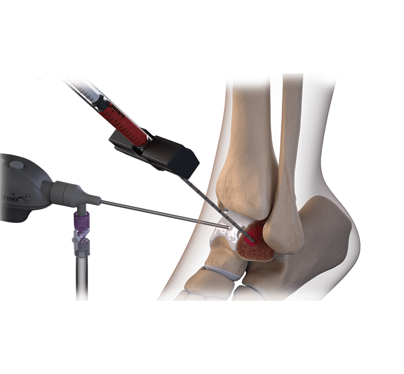 IntraOsseous BioPlasty® Technique for Foot and Ankle