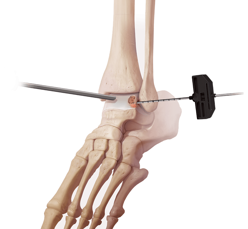 IntraOsseous BioPlasty® Technique for Foot and Ankle