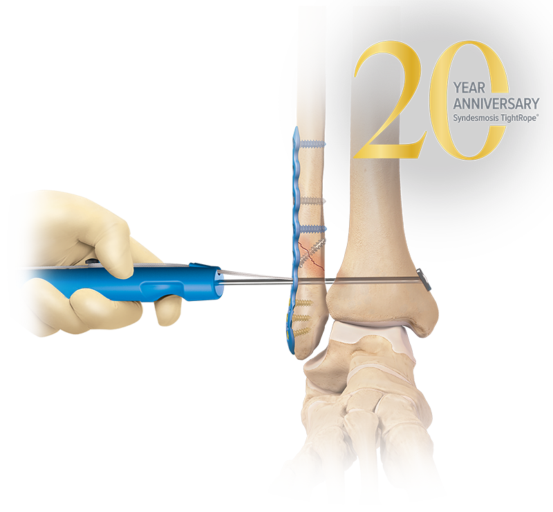 Syndesmosis Repair