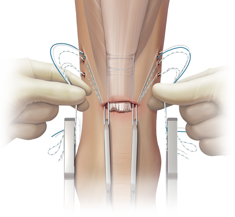 Técnica de sutura FiberWire<sup>®</sup> para la ruptura del tendón de Aquiles