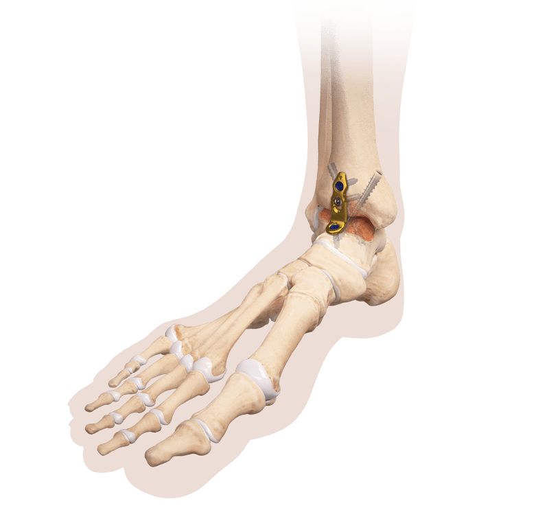 Ankle Fusion