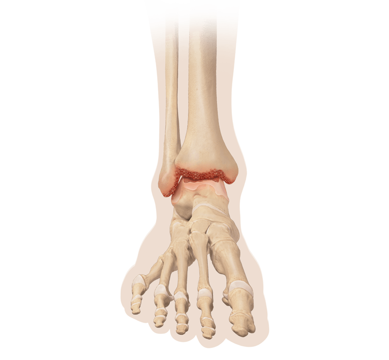 Ankle Arthritis