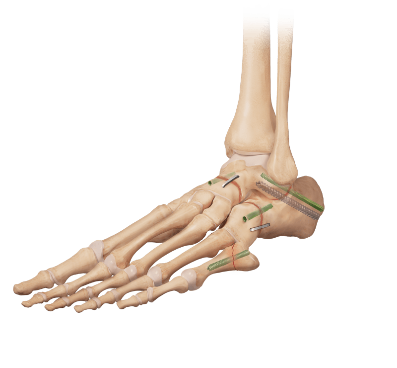 Triple Arthrodesis