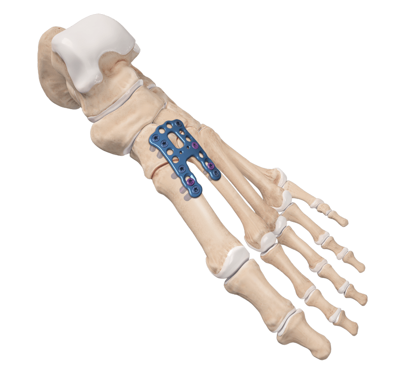 Lisfranc Arthrodesis