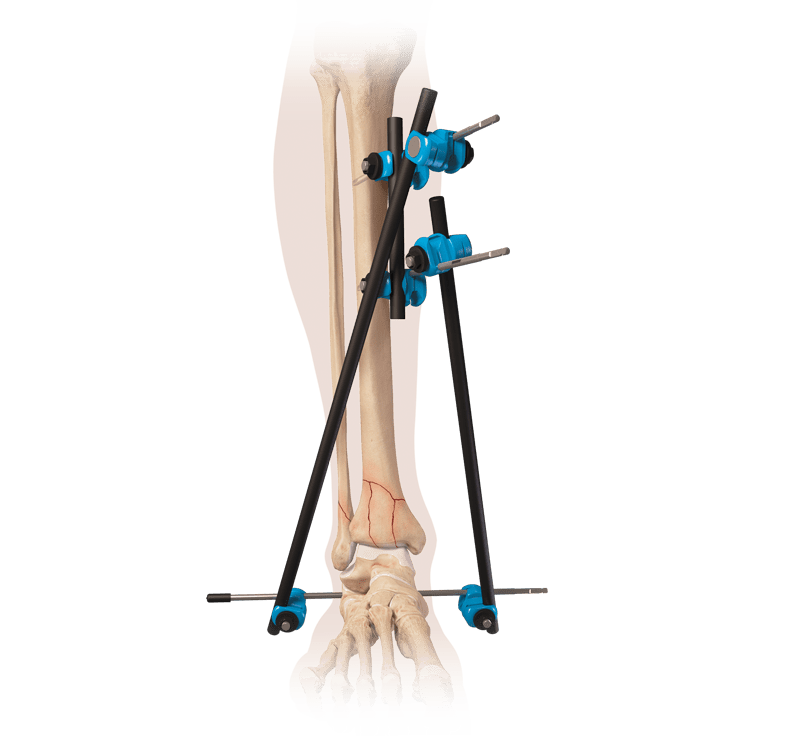 ArthroFX® Large External Fixation System