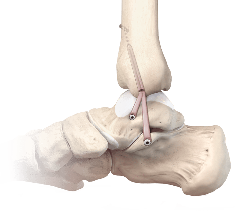 Deltoid Ligament Reconstruction