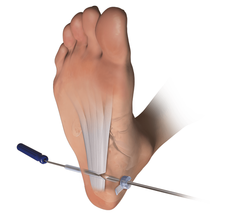 Endoscopic Plantar Fascia