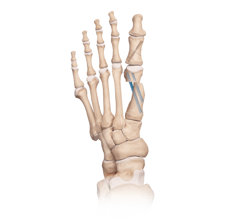 First Metatarsal Osteotomy