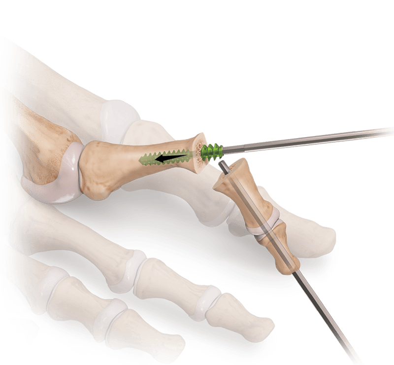 Implante RetroFusion™ para artrodesis de la articulación PIP
