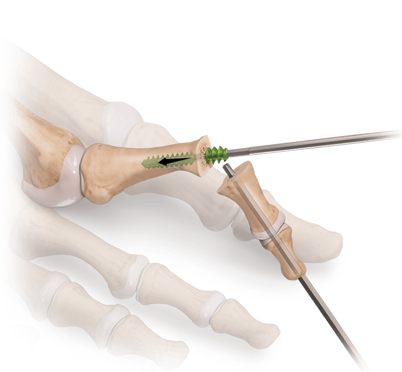 RetroFusion™-Implantat für die Arthrodese des PIP-Gelenks