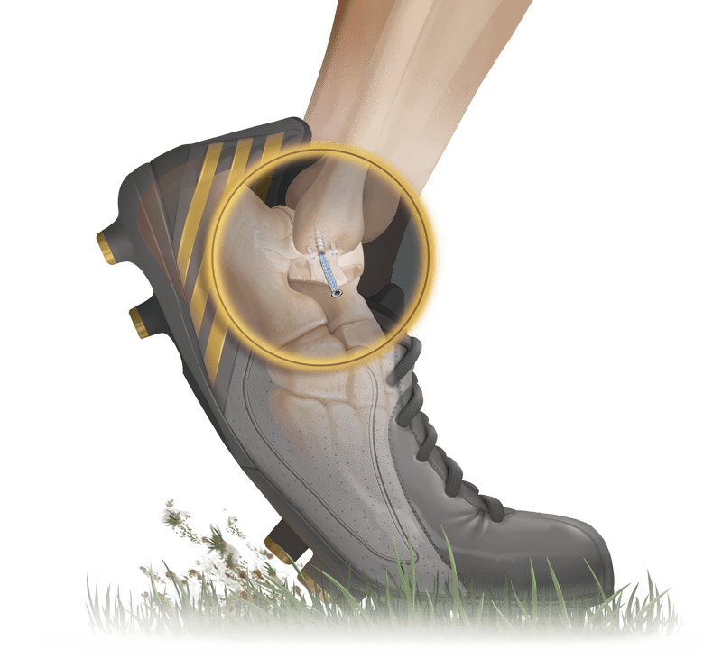 Técnica de reparación de Brostrom con <em/>Internal</em>Brace™