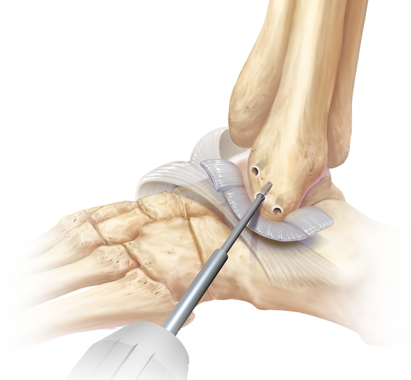 Lateral Ankle Instability