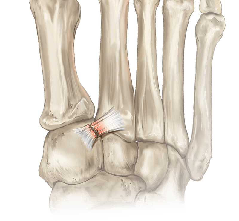 Deslocamento de Lisfranc