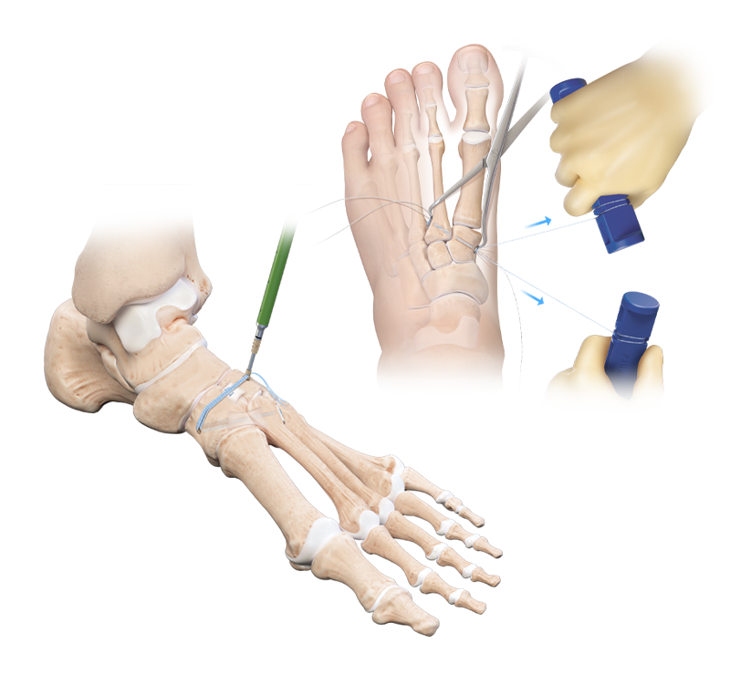 Lisfranc Injury Fixation