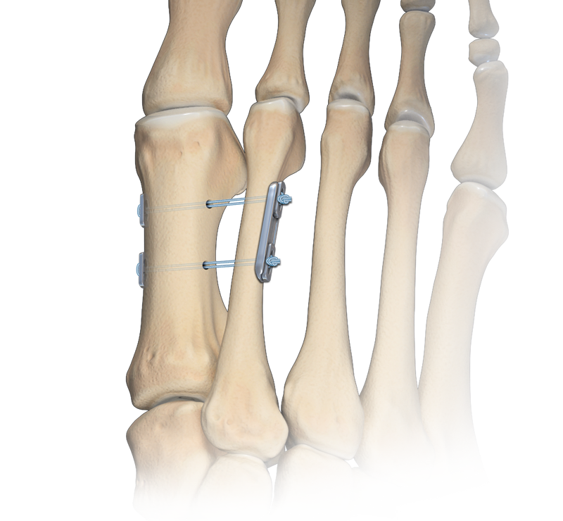 Mini TightRope<sup>®</sup> Technique for Hallux Valgus