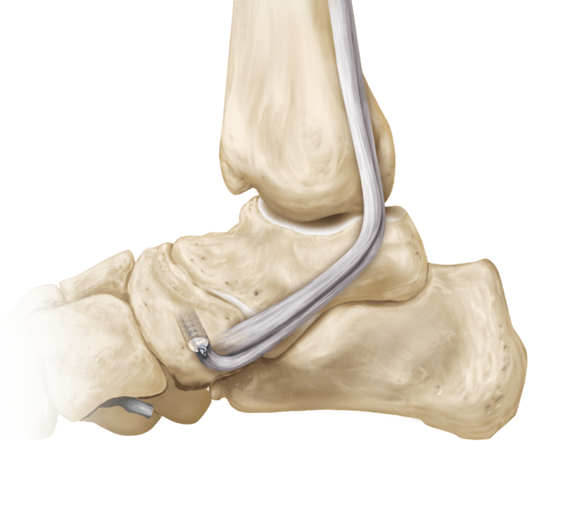 Posterior Tibialis Tendon Transfer