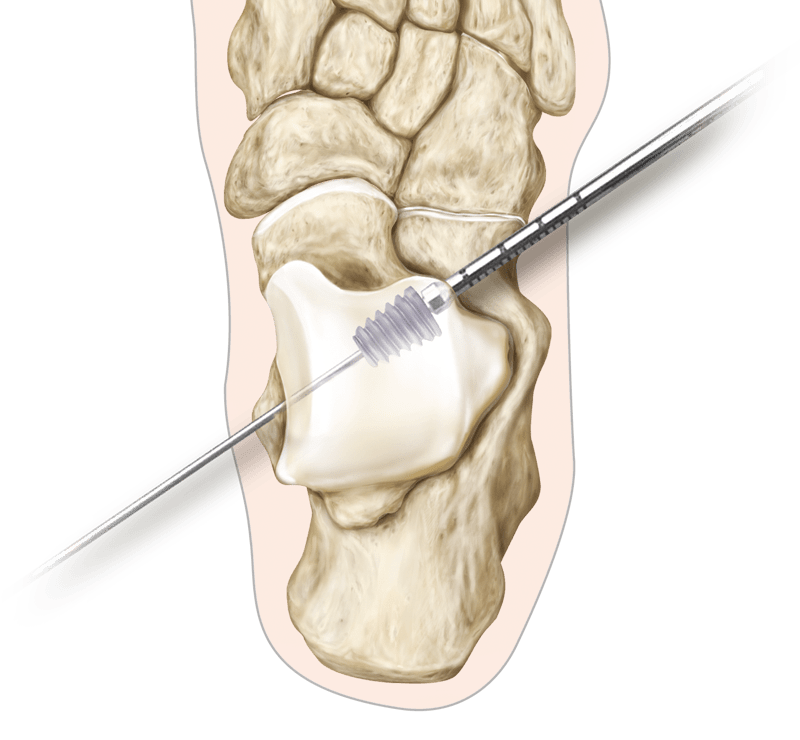 ProStop<sup>®</sup> Arthroeresis