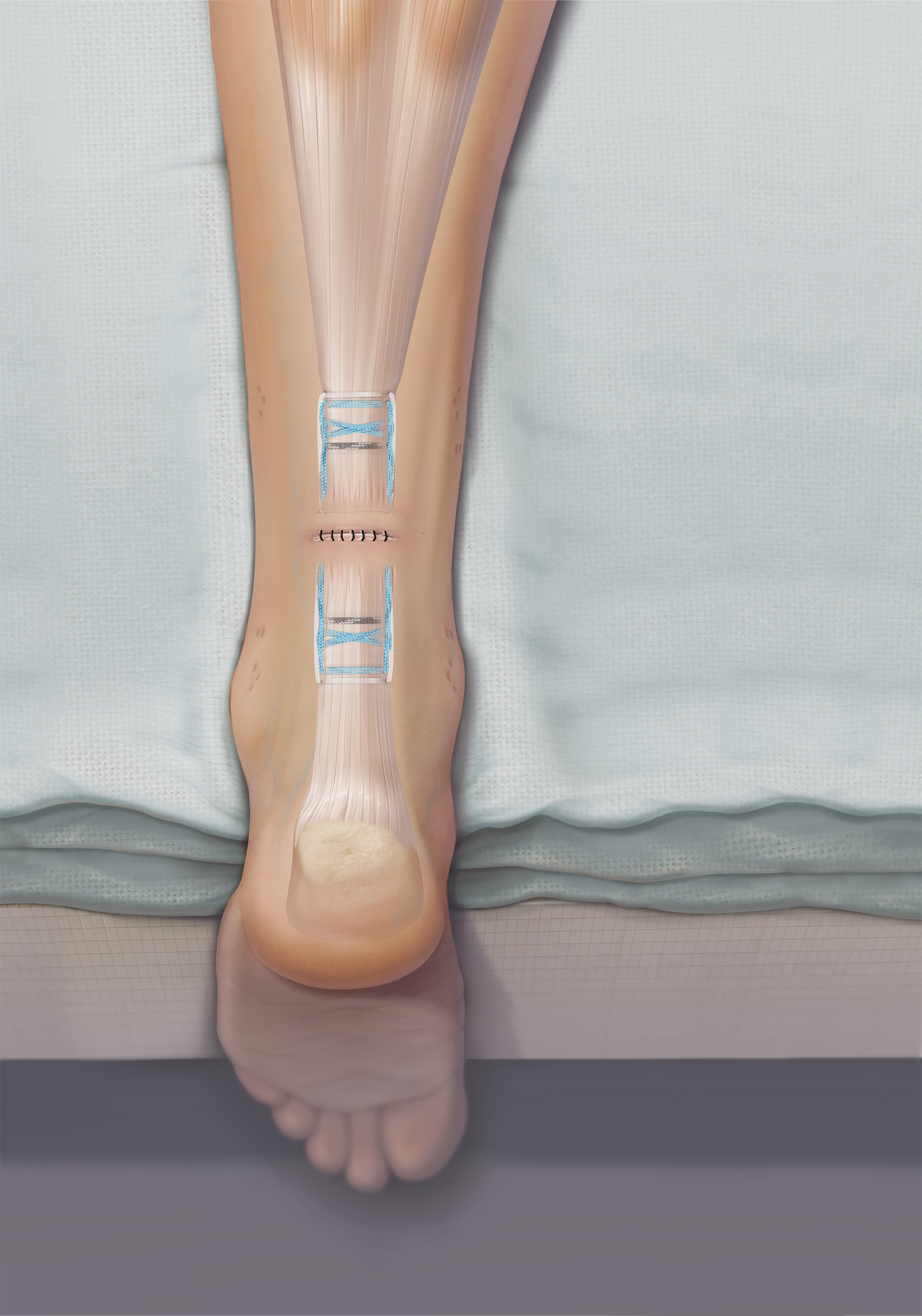 PARS Achilles Jig System