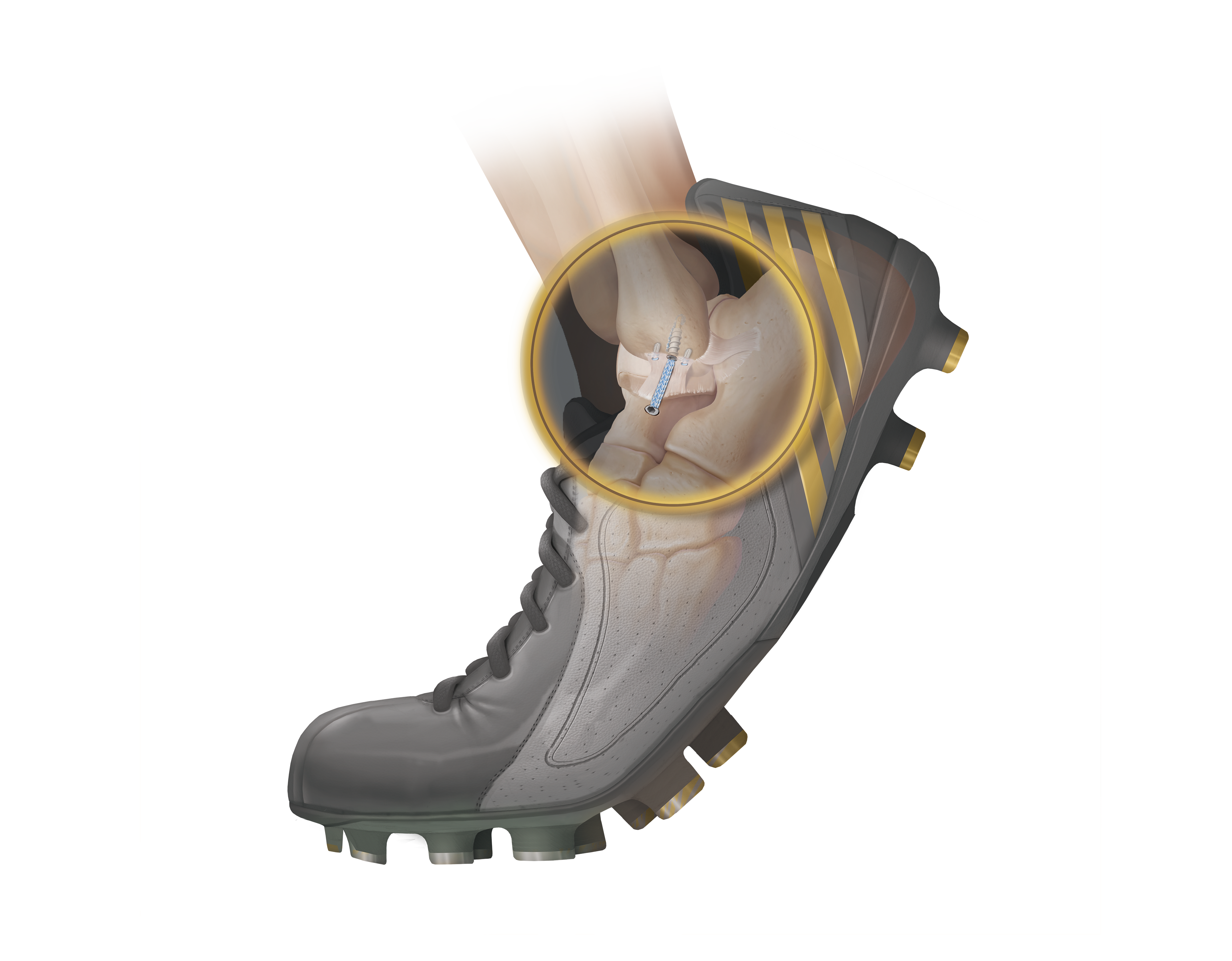 <em>Internal</em>Brace™ Procedure for Brostrom Repair
