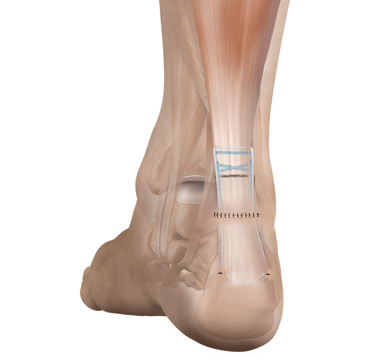 PARS Achilles Midsubstance
 SpeedBridge™ Implant System