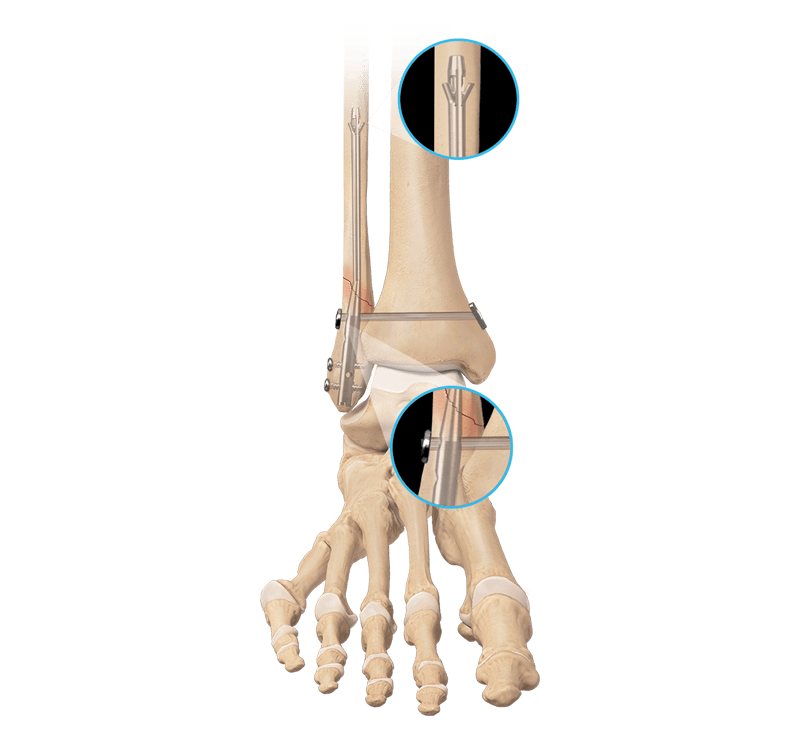 FibuLock<sup>®</sup> Fibular Nail