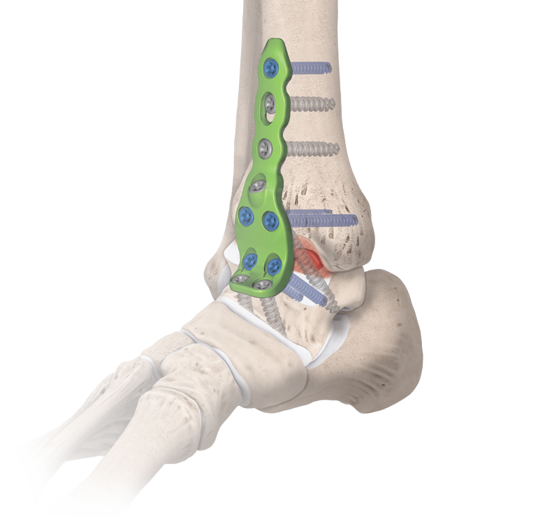 Ankle Fusion Plating