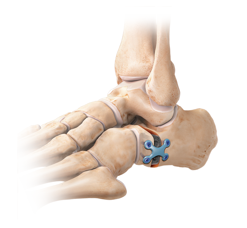 BioSync<sup>®</sup>-Osteotomiekeile