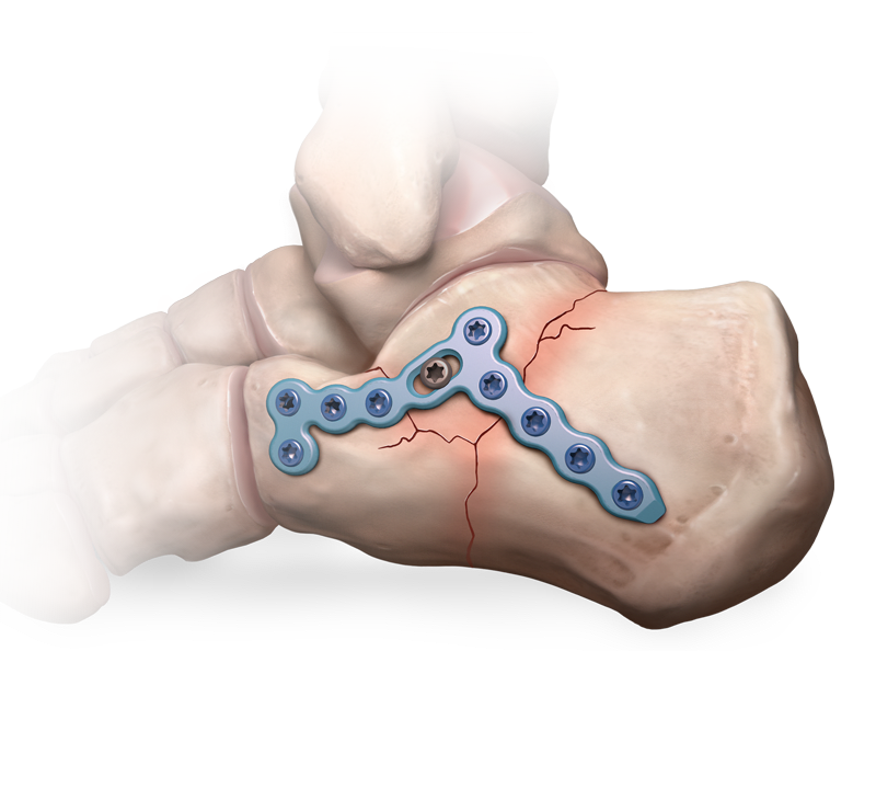 Calcaneal Fracture
 System