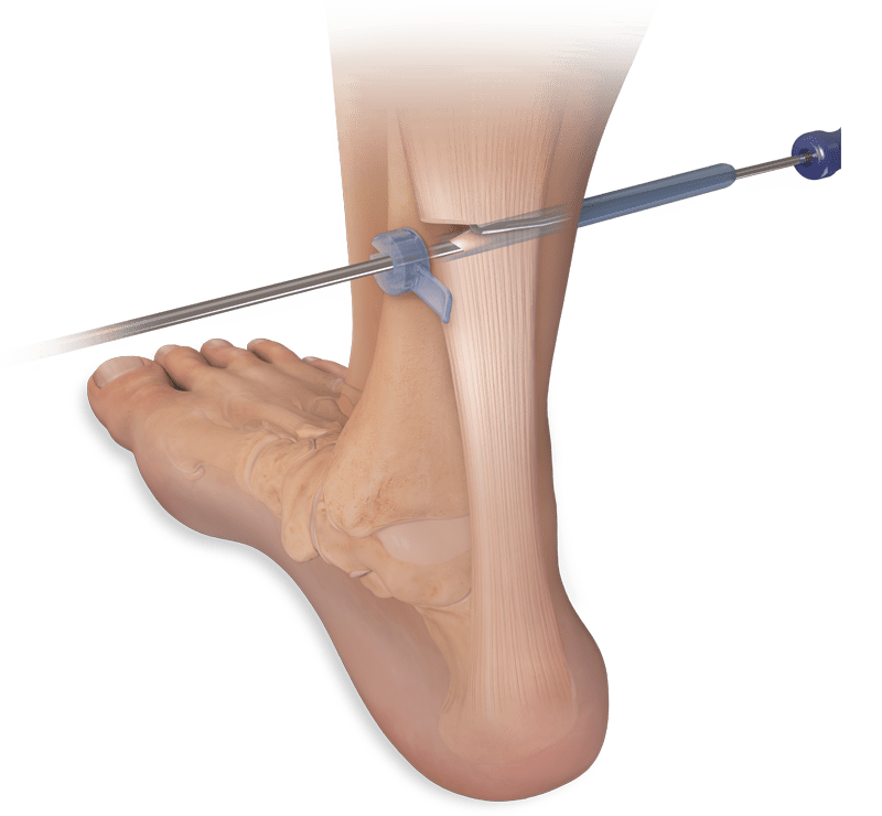 Endoscopic Soft-Tissue Release