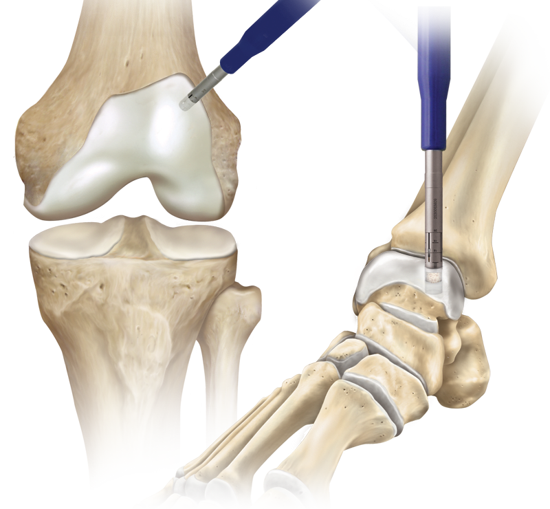 Cartilage Autograft