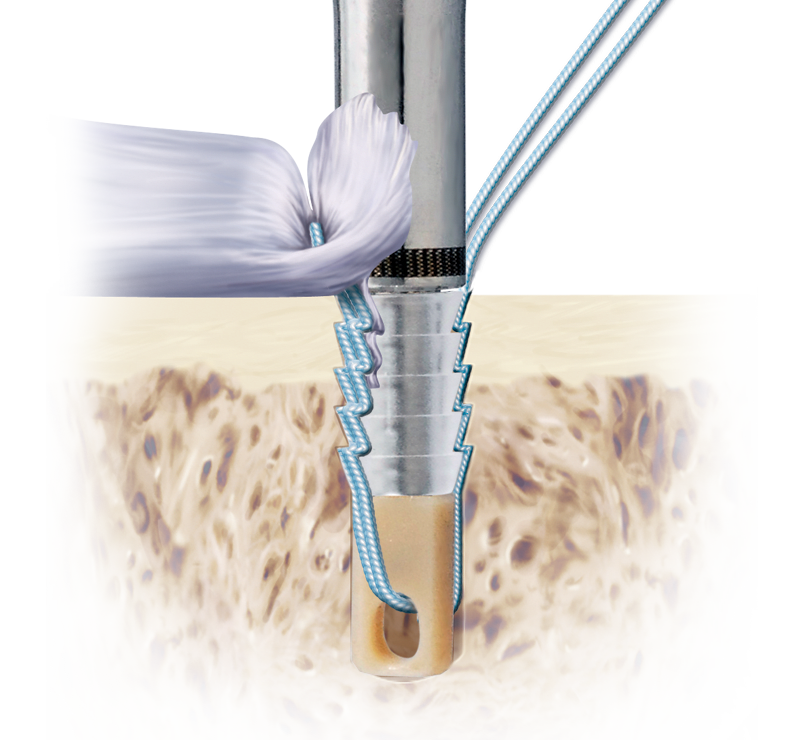 Knotless Suture Anchors