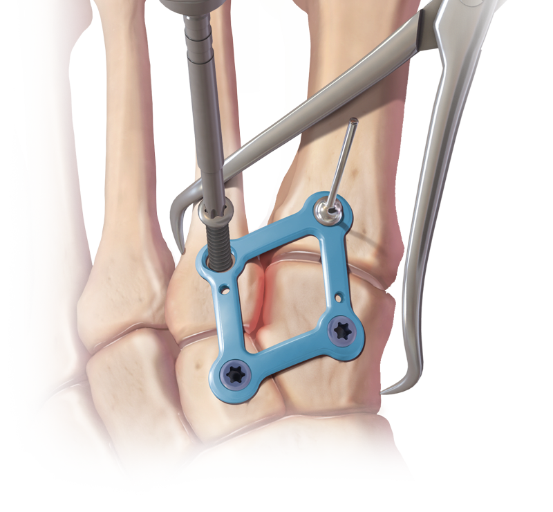 Lisfranc Plates