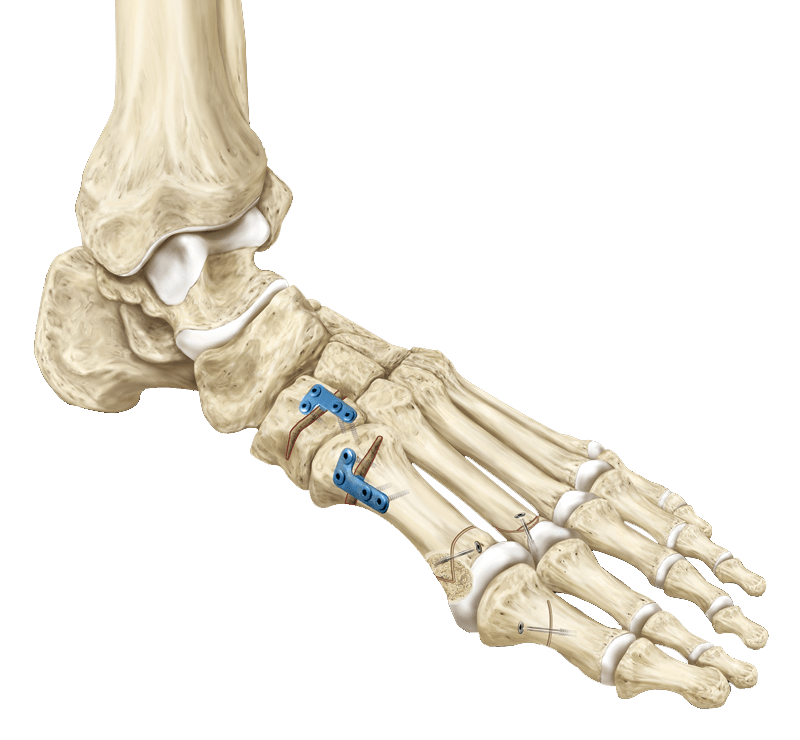 Low Profile Opening Wedge
 Osteotomy Plates and Screws