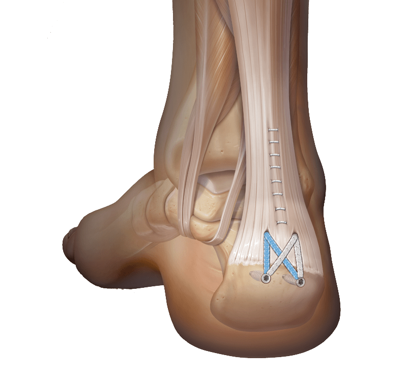 Achilles SpeedBridge™ Repair