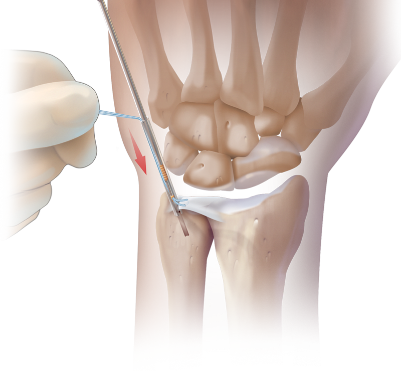 Arthroskopische knotenlose TFCC-Rekonstruktion mit dem PushLock<sup>®</sup>-Anker